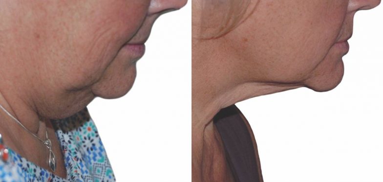 Lift-Before-and-After-07