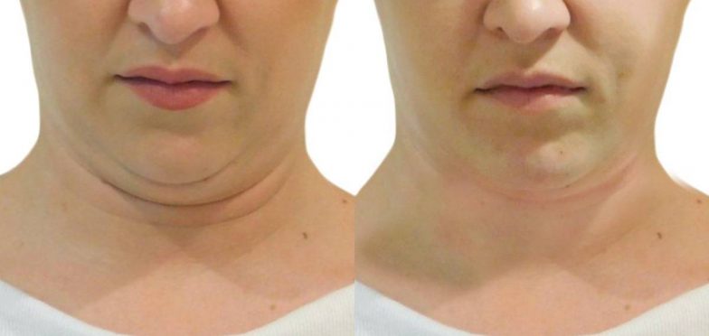 Lift-Before-and-After-12