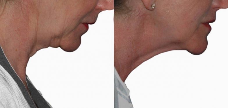 Lift-Before-and-After-13