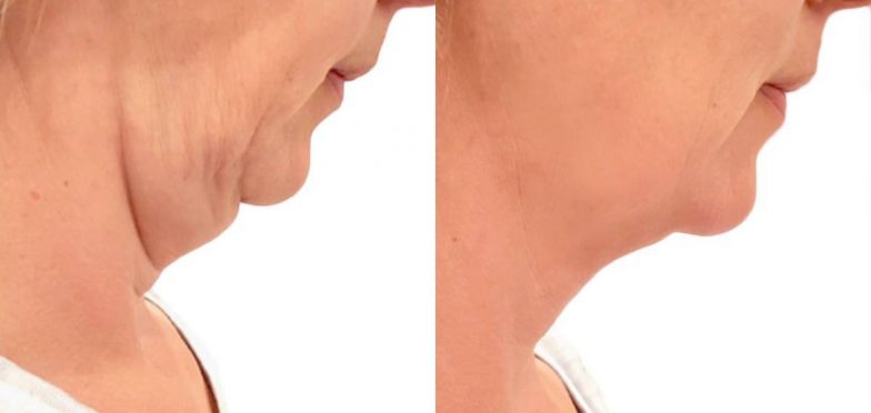 Lift-Before-and-After-23